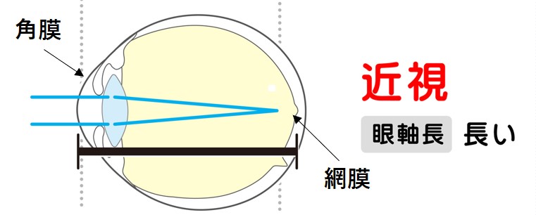 病的近視（強度近視）とは